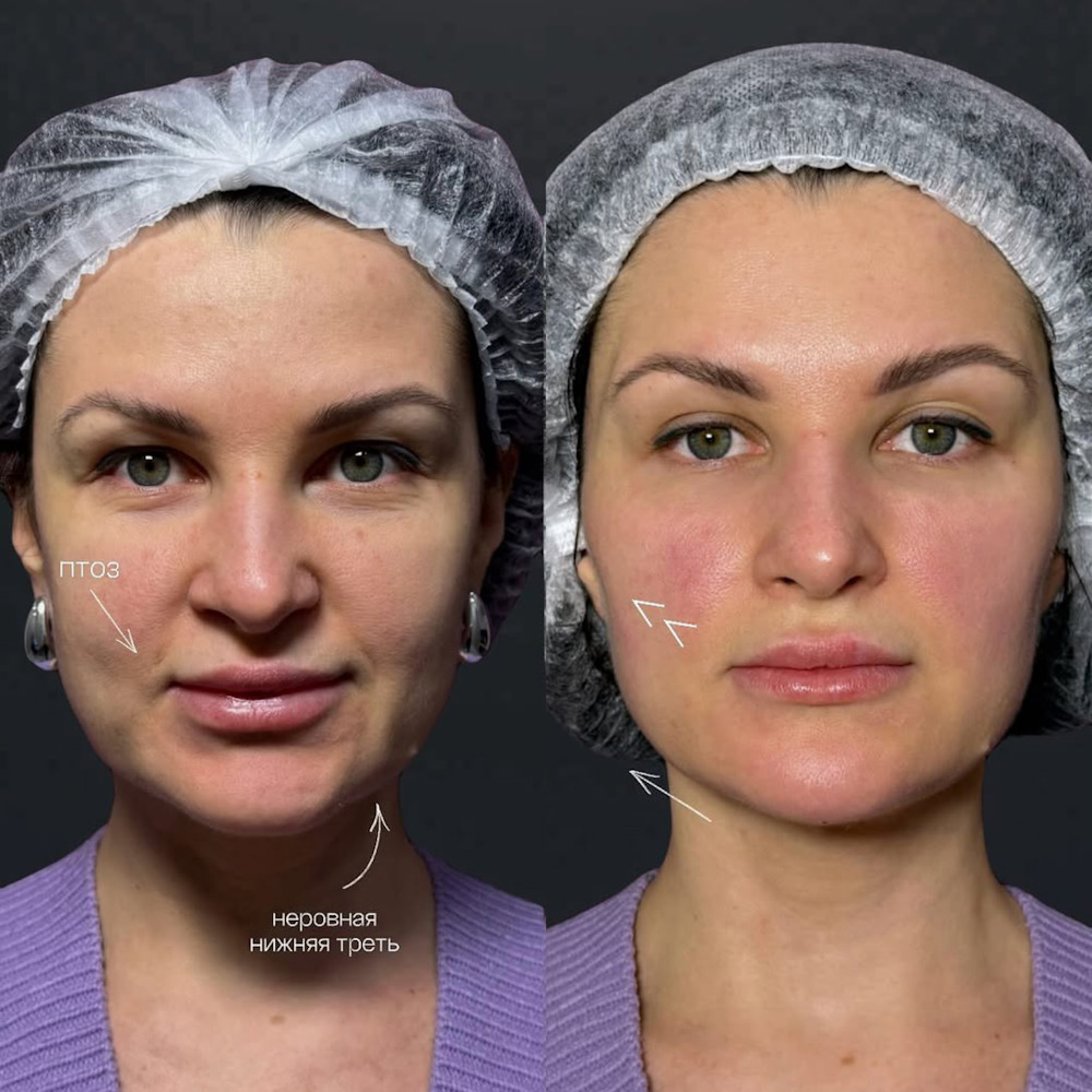 Контурная пластика лица